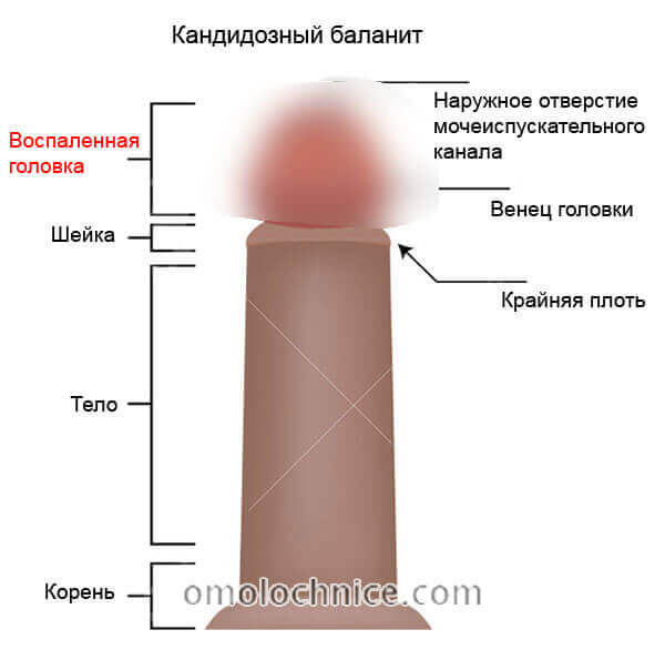 Кандидозний баланопостит Кандидозний баланопостит