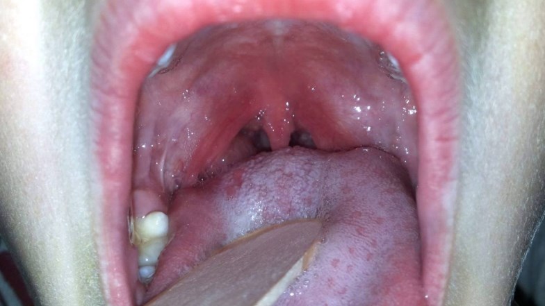 Дифтерія: причини, симптоми, діагностика, лікування