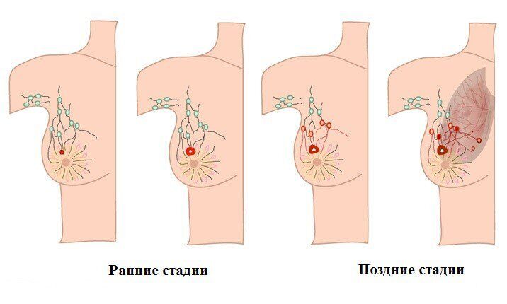 Лечение рака молочной железы - на что обратить внимание?