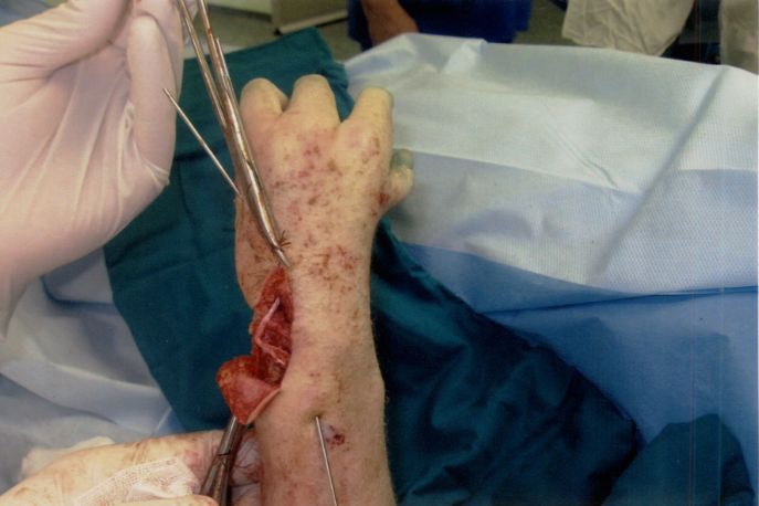 Спосіб лікування вродженої косорукості