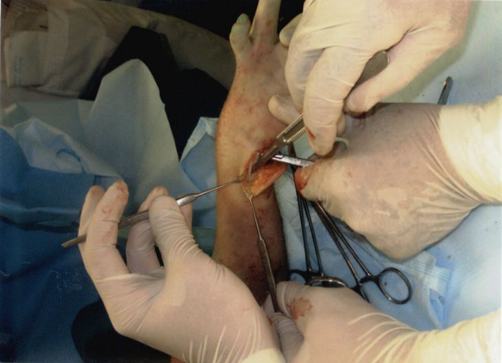 Вроджена косорукість Вроджена косорукість