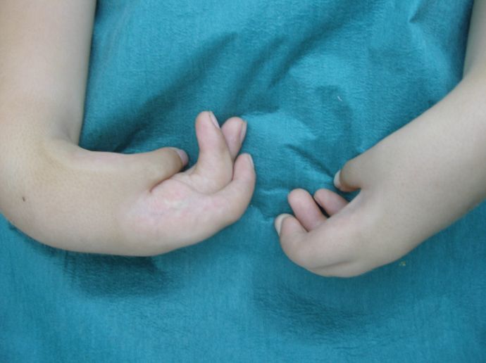 Як жити з вродженою косорукістю?