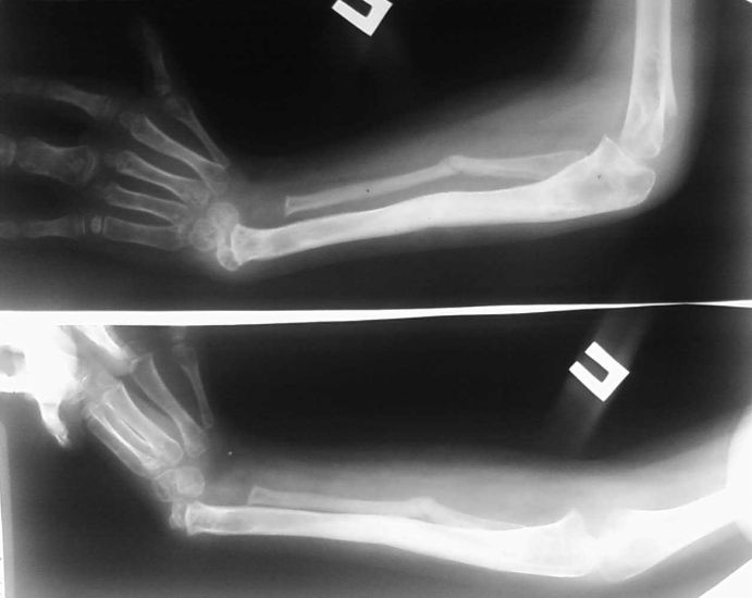 Вроджена променева косорукість