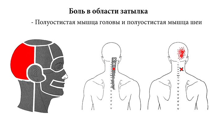 Біль у потилиці: чому виникає, як лікувати, на що звернути увагу