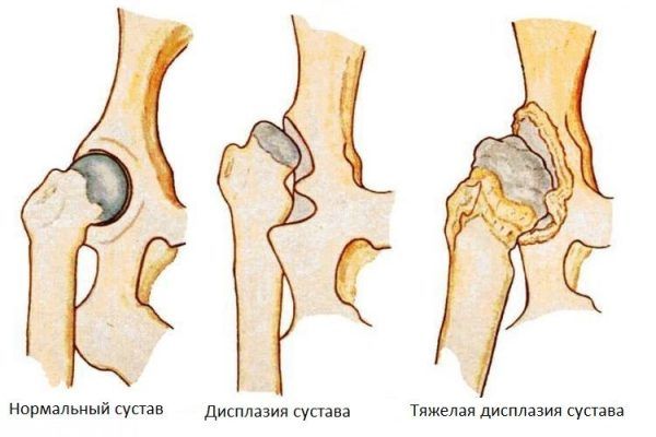 Що таке дисплазія та як вона проявляється. Причини та симптоми захворювання