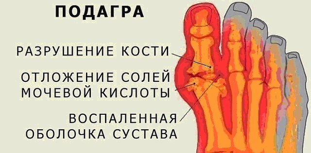 Що таке подагра, як вона проявляється у чоловіків і жінок, чим лікується це захворювання