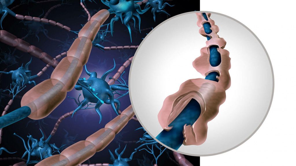 Що таке розсіяний склероз, як він проявляється і чим лікувати захворювання