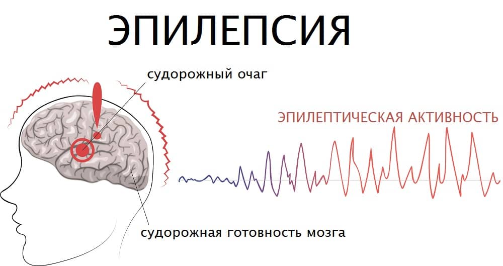 Епілепсія - причини, діагностика, лікування
