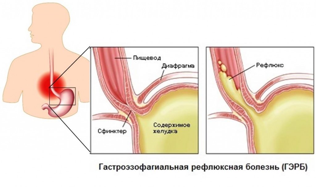 Гастроезофагеальна рефлюксна хвороба (ГЕРХ)