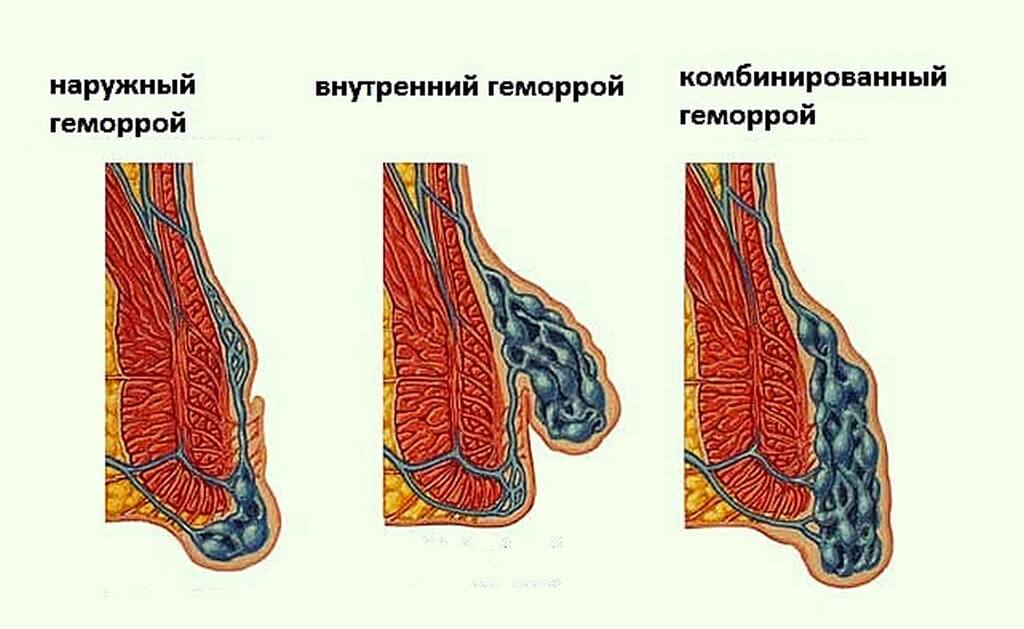 Геморой: причини, види, методи лікування та наслідки для здоров'я