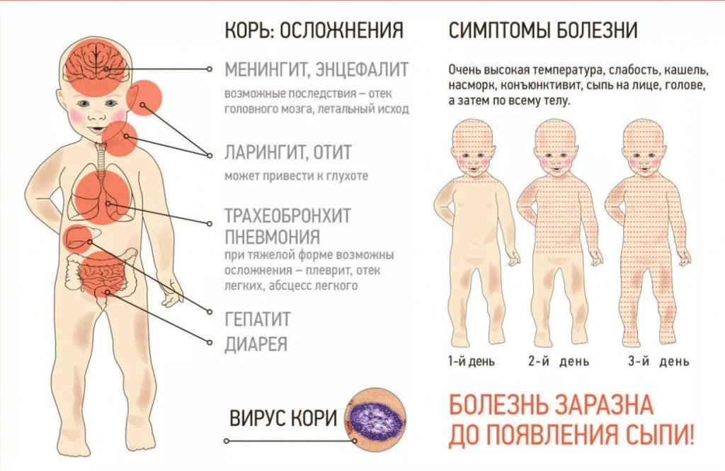 Кір: що це таке, в чому полягає ризик захворювання, як захиститися