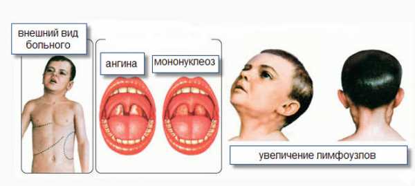 Що це мононуклеоз? Симптоми, лікування, профілактика