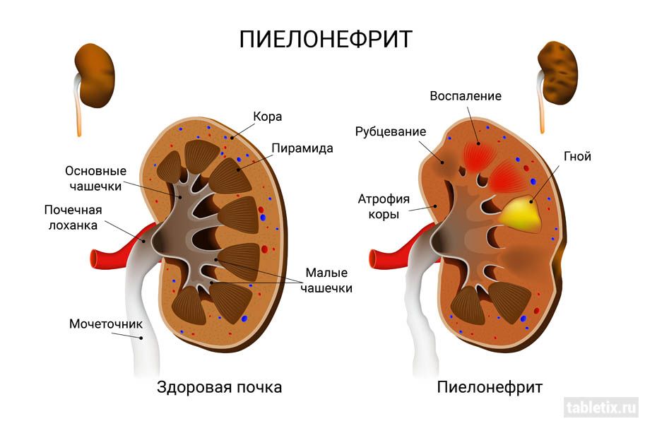 Пієлонефрит: опис, причини виникнення, симптоми та методи лікування