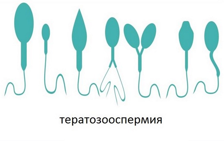 Тератозооспермія у чоловіка: що це таке, як її лікувати, чи можлива вагітність та які наслідки для дитини?
